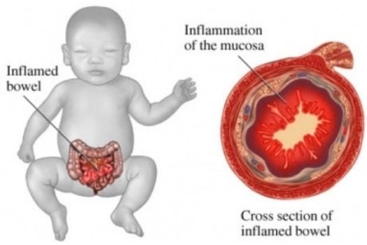 Treating NEC in a Preterm Infant Newborn Baby