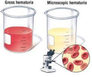 WHAT TO DO WHEN YOU SPOT BLOOD IN THE URINE